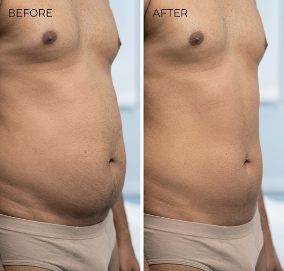 body-contouring-surgery.png